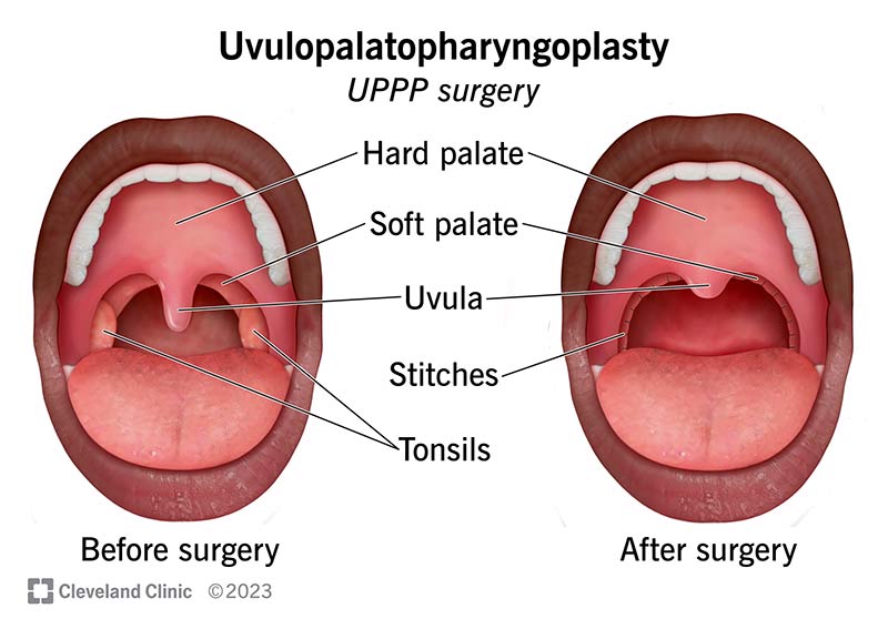 UPPP Surgery uvulopalatopharyngoplasty